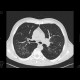 Thickening of intralobular interstitium, HRCT: CT - Computed tomography